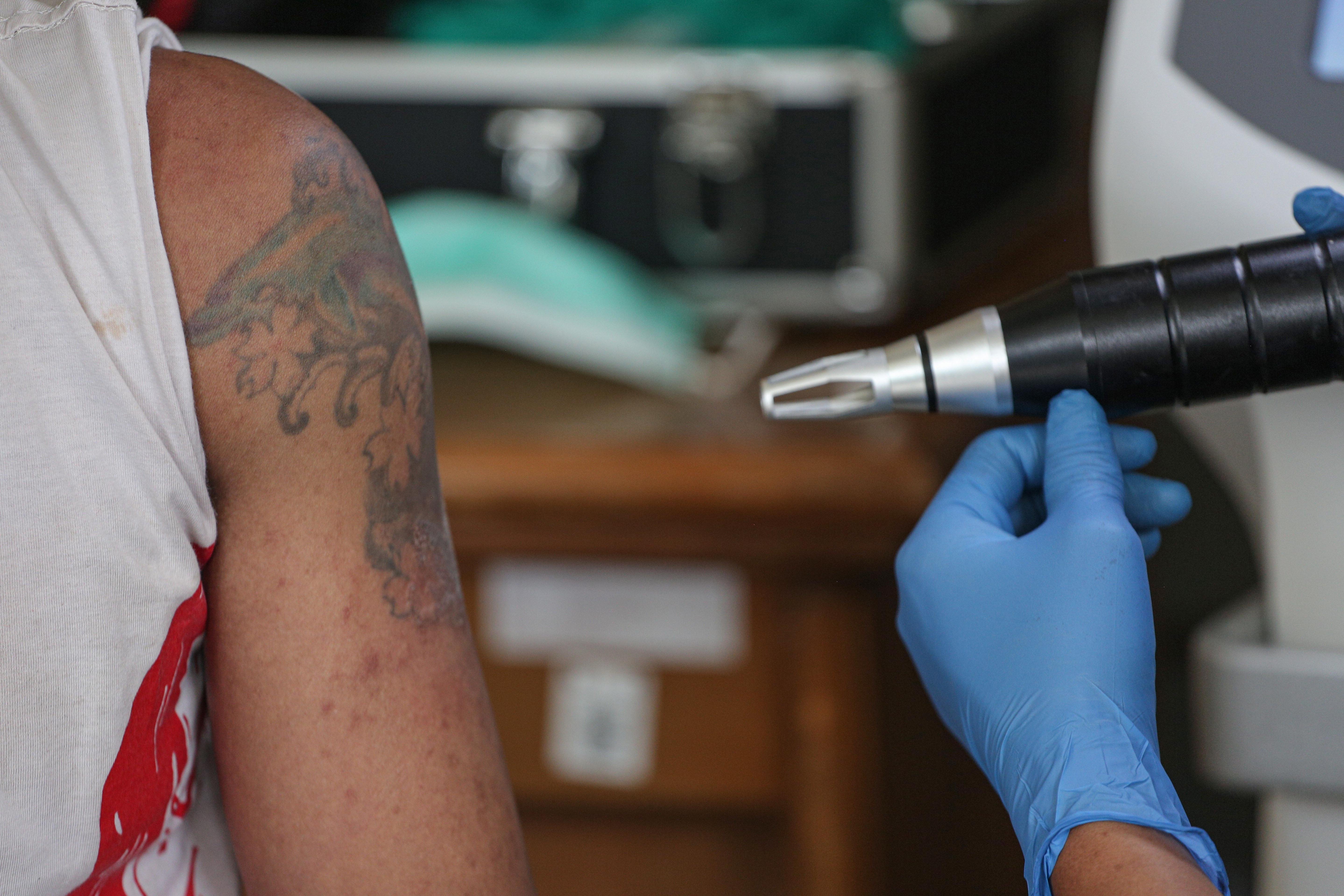 Petugas menghapus tato warga menggunakan laser di Masjid Agung Sunda Kelapa, Menteng, Jakarta Pusat, Selasa (24/2/2026). Kegiatan yang digelar oleh Baznas/Bazis DKI Jakarta ini bertujuan memberikan kesempatan kepada masyarakat yang ingin berhijrah dan memperbaiki diri melalui penghapusan tato secara gratis, aman dan sesuai prosedur medis.