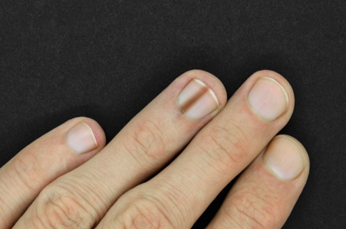 Cara Menghilangkan Garis Hitam Di Kuku