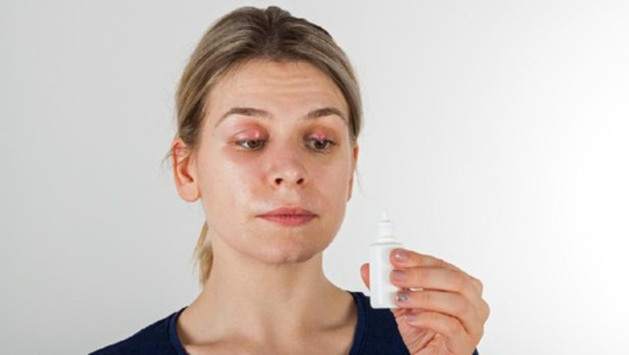 Cara Menyembuhkan Mata Bintitan