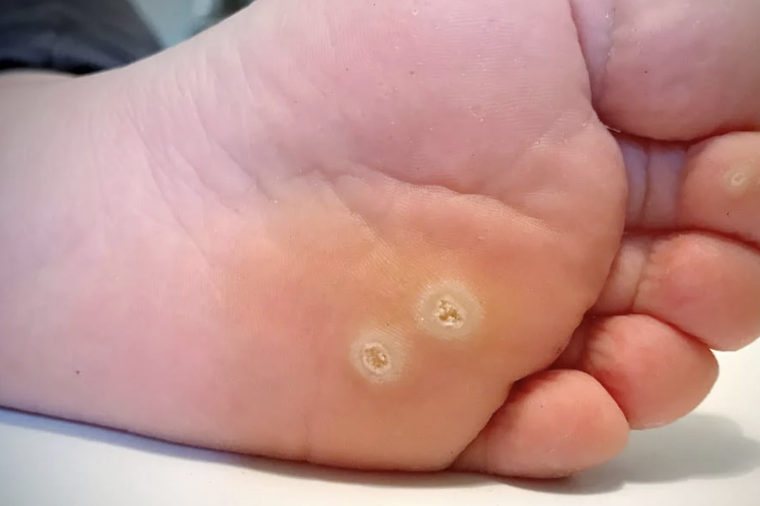 Penyebab Mata Ikan di Kaki