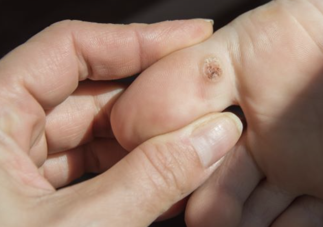 Penyebab Mata Ikan di Kaki