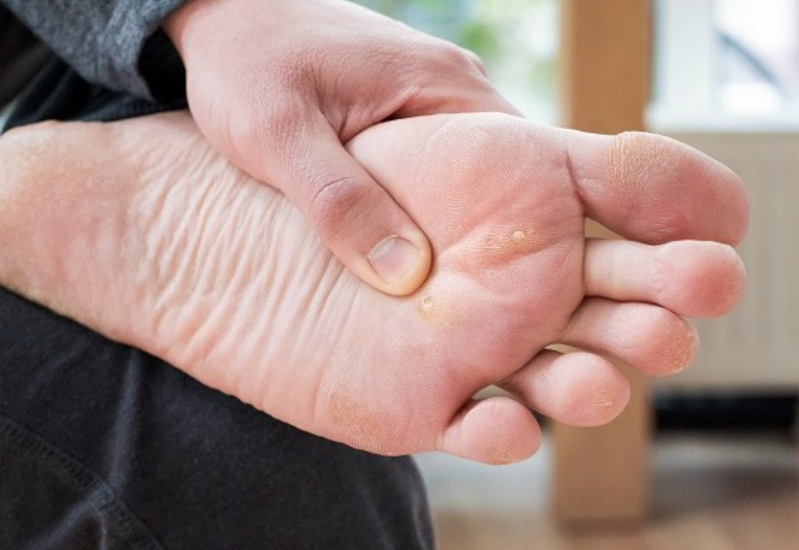 Penyebab Mata Ikan di Kaki