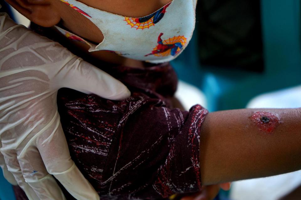 Seorang dokter memeriksa kondisi bocah yang terkena antraks kulit di Dusun Marisa, Desa Daenaa, Kabupaten Gorontalo, Gorontalo, Rabu (10/6/2020). 