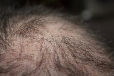 Alopecia penyakit apa