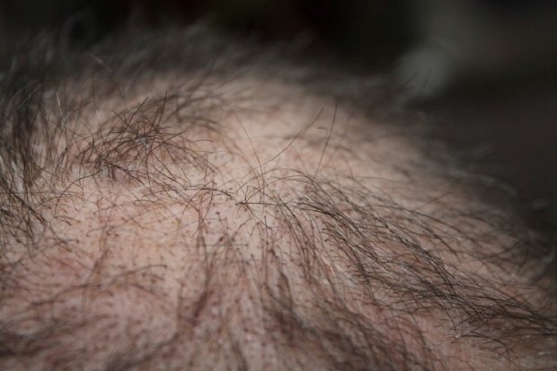 Mengenal Alopecia Areata, Penyebab Rambut Rontok Akibat Autoimun
