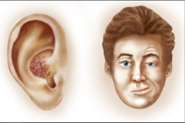 Ramsay Hunt Syndrome