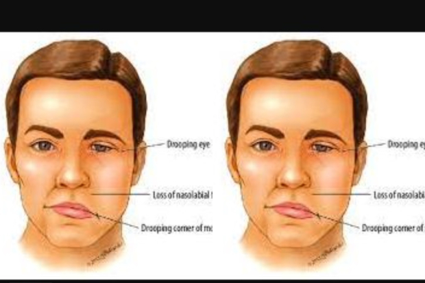 Ramsay Hunt Syndrome