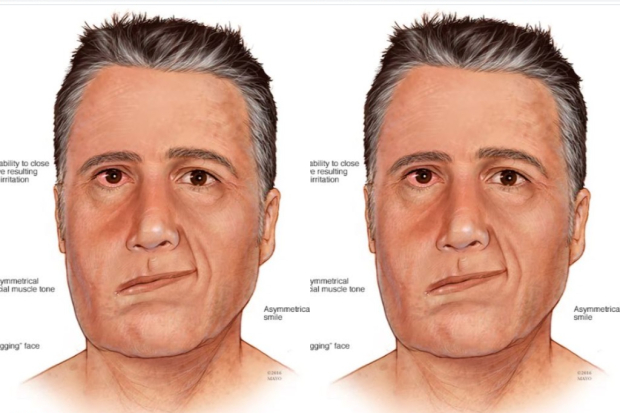 Ramsay Hunt Syndrome