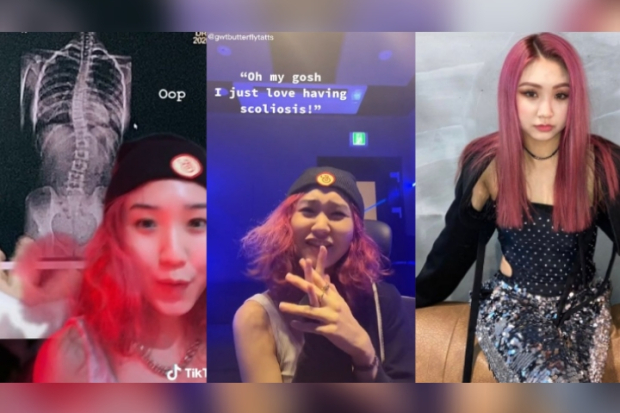 Denise ex Secret Number alami kelainan tulang