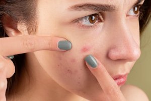 Ilustrasi, rekomendasi skincare untuk kulit berjerawat