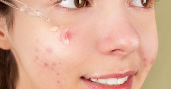8 Skincare untuk Menghilangkan Bekas Jerawat dalam Bentuk Serum