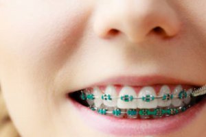 Cara Sikat Gigi yang Benar Bagi Pengguna Behel