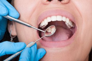 Cara Menghilangkan Bau Mulut karena Gigi Berlubang