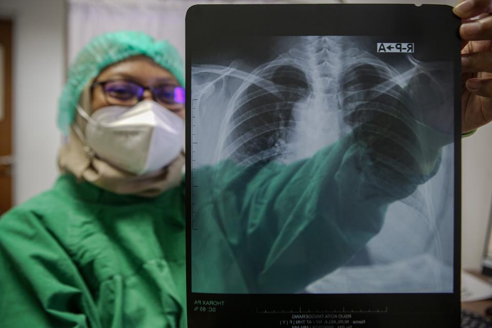 Tenaga kesehatan menunjukkan hasil rontgen thorax salah satu pasien di RSUD Kota Tangerang, Banten, Selasa (21/3/2023). Pemerintah Kota Tangerang melalui Dinas Kesehatan melakukan deteksi tuberkulosis (TBC) gratis kepada 1.000 orang penyandang diabetes me