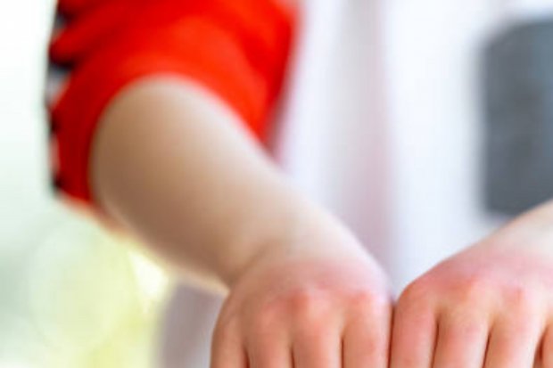 7 Penyebab Penyakit Gatal Pada Kulit