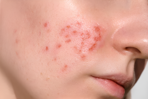 Tanda Herpes di Wajah