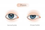 Apa itu Ptosis 