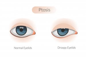 Apa itu Ptosis 