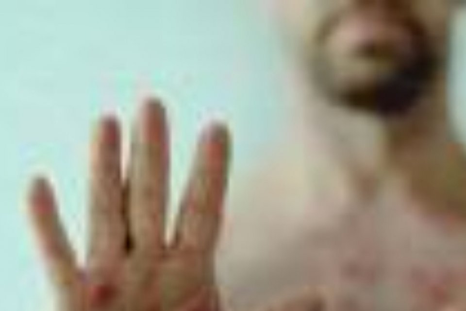 campak, bahaya campak, dokter meninggal